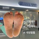 내성발톱 교정은 이천 문제성 발 전문 라파엘이 최곱니다