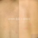 더피유에스테틱 | 운정 등관리 "썸굿 경기북부점 (구 '피유 에스테틱')" 후기 (바디필링3회차/등드름관리/통증/가격...