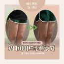 중장년 건강 관리 운동법 | [수원/한의원] 다이어트 지방분해주사 5회차 후기 (효과, 비포애프터 사진)
