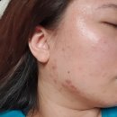 에버유의원 | 마포 여드름 치료 과정 기록 #내돈내고 에버유의원