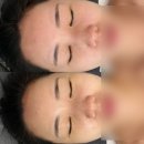 논현피부관리 어나더핸드 - 무너진 피부 장벽 관리 후기