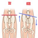 골반교정 필라테스 이미지