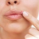 입술 주변 수포 원인 혹시 입술 수포 전염될까 이미지