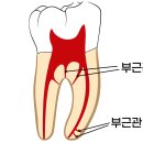 모란상아치과의원 | 모란역 치과 신경치료 완료 후 심한 통증의 이유는? 놓치기 쉬운 부근관에 대해서