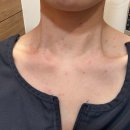 수원역광장 한의원 | 수원역광장한의원 후기(편사, 쥐젖, 점 제거)