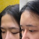 마인성형외과의원 | 부산이마필러 잘하는곳 다녀온날:)