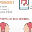 디제이식품 | 치질 수술 5주차 후기 | 여전히 안 가라앉는 붓기