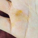 일광 척 정형외과 손바닥 물혹(결절종) 제거 후기(기장 병원)