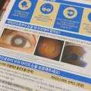 베니스안경원 | 본오동 안과추천으로 맞춘 마이오스마트렌즈 근시억제안경 인정!