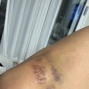 멍이가 웃통벗는날 | 발등미세골절인가 염좌인가 반깁스 후기 - 댓거리정형외과후기포함