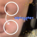 저지한의원 | 센텀피부과추천 부산포텐자, 라보센 엑소좀스킨부스터로 모공관리 받은 후기