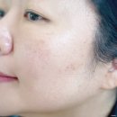 여드름약 알아보다 포아크네 이소틴정 화농성 여드름 피부 관리법으로 픽!