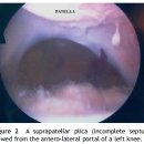 synovial plicae of the knee - 무릎 굴곡 70-100도에서 대퇴사두근 건과 femoral trochlea사이에서 끼임. 이미지