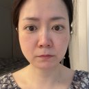 (주)더프라자 청담 | 팔자주름 시술 추천 만족도 최상 청담 튠페이스, 스컬트라 후기