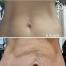 동대문피부관리 김선희피부S라인뷰티샵 플라즈마관리 후기~♡