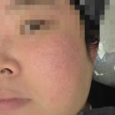 후한의원 - 부산진구 | 수원지루성피부염 수원역피부과 후한의원 수원점 다녀본 후기