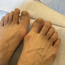 풋스올경기 | 수원무좀발톱관리 - 전문적인 수원발관리 풋스올에서 받은 발톱 스케일링 후기