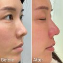 부산피부과추천 | 수술없이 예쁜 코끝 만들어주는 코조각주사 후기(통증, 시술팁, 가격)