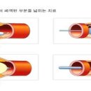 죽상동맥경화증 이미지