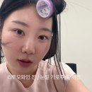 35 | 눈밑주름 피부과 시술, 리쥬란 말고 리투오 받은 이유 (다 해본 35살 후기)