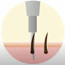 다나성형외과의원 | 전현무 탈모 병원 강남 모발이식 위치와 비용 총정리