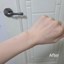 맥스 1호 | 송도피부과 젠틀맥스레이저 1차 후기 송도제도 팔 제모 후기