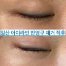 [뷰티/일산] 내돈내산 반영구제거, 눈썹문신제거, 아이라인제거, 노데미지반영구제거 : 율스토리