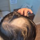 더위아 | 선천성 피지선 모반 위아더성형외과 수술 후기