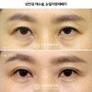 처진눈수술 후기 회복기간 주의사항 정리