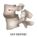 요추 전방전위증[Lumbar spondylolisthesis] 이미지