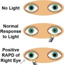 Pupil reflex 임상에 응용하기 - 반짝반짝 눈이 부셔 이미지