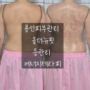 용인피부관리 올더뉴핏 등관리 비포&amp;애프터 에너지테라피 후기!