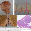 에코유방역.에코유환경 | 논문 리뷰 : A case of BIA-ALCL in which postoperative chest wall recurrence was highly suspected