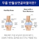 무릎 연골 찢어짐 반월상 연골파열 주의보 : 증상 및 원인과 치료 방법 이미지