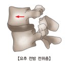 요추 전방위증 이미지