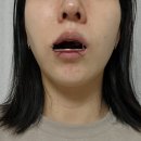 김종구희망드림치과의원 | 턱관절 교정기 6개월 후기, 이건 진짜 잘했다 싶음