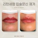 광주 리턴세럼 입술 문신 제거 후기 / 망한 반영구 잔흔 레이저보다 저통증으로 지우는 방법