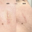더드림한의원 | 부산 한의원 여드름 흉터치료 새살침 5회차 내돈내산 총정리 후기