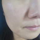 용한의원 | 천안 여드름 흉터 전문한의원 3회차 내돈내산 후기