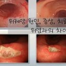 윗배통증 원인 상복부통증 이미지