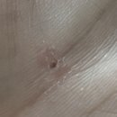 사마귀 제거 냉동+자가+레이저치료. 생명선 위 사마귀