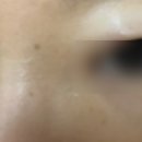 멘토의원 아이라인 반영구 제거시술 후기(광고x)