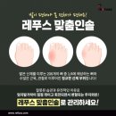 레푸스 이미지