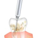 박준범치과의원 | 치과의사도 하기 싫은 치료? 환자도 힘든 치료 - 잇몸 치료의 현실과 중요성[광주화정동치과]