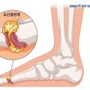 '극심한 통증' 남성 위협하는 통풍…"고기·맥주 피하세요" 이미지