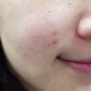 휴가다녀와서 뒤집힌 내 피부 여드름 일주일만에 극복한 후기 (사진有혐오주의,스압주의) 이미지