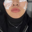 본피부과의원 | 신논현피부과 필로드 쁨의원 비포에프터 2cc리쥬란 꾸준히 맞던 내가 필로드로 갈아탄 찐이유