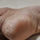 르사(LSA) | 발바닥 껍질 벗겨짐 가려움 무좀약으로 해결