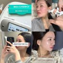 마산1 | 마산 피부과 벨로테로 리바이브 스킨부스터 1cc 후기 : 효과 통증 엠보 전후 비교 등등