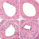 새로이 Lab | 메지온 - 비만치료제말고 폰탄치료제